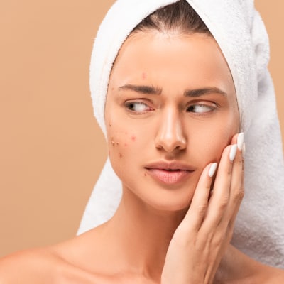 ACNE TREATMENTS